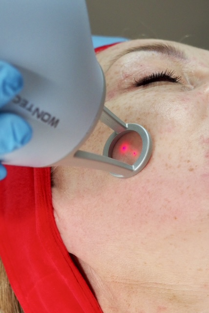 Laser tulowy – Anna Stelmach Clinic
